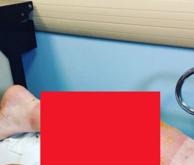 S-a copt la soare! Cum arată picioarele unei femei care a alergat 21 de ore fără oprire