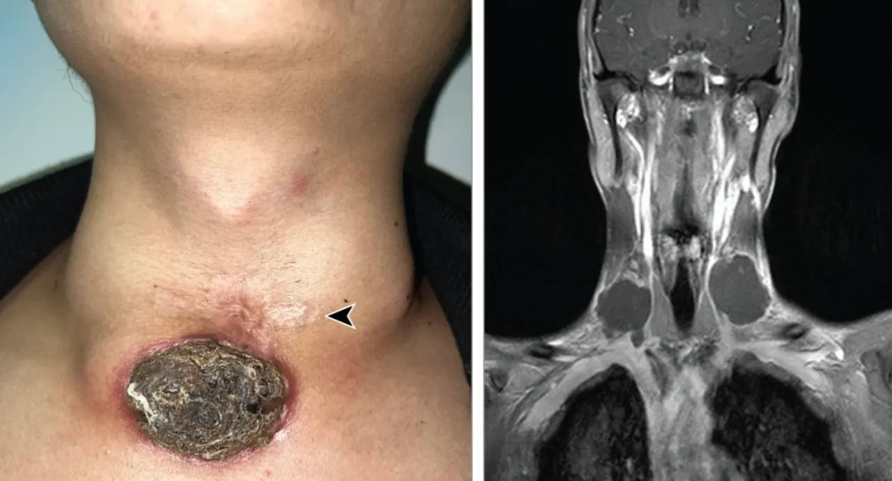 Un tatuaj în formă de cruce pe gâtul unui tânăr s-a transformat într-un ulcer necrotic