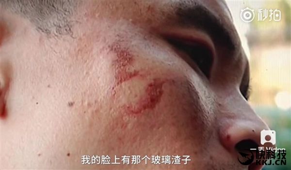 iPhone 7 взорвался перед лицом владельца