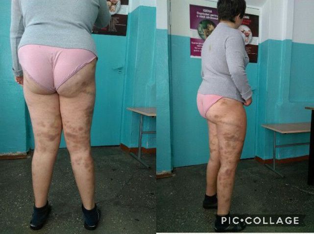Coșmarul unei mame. O adolescentă a fost umplută de vânătăi în Spitalului Clinic de Psihiatrie din orașul Codru