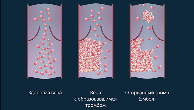 Физики из МФТИ научились уничтожать тромбы при помощи лазера