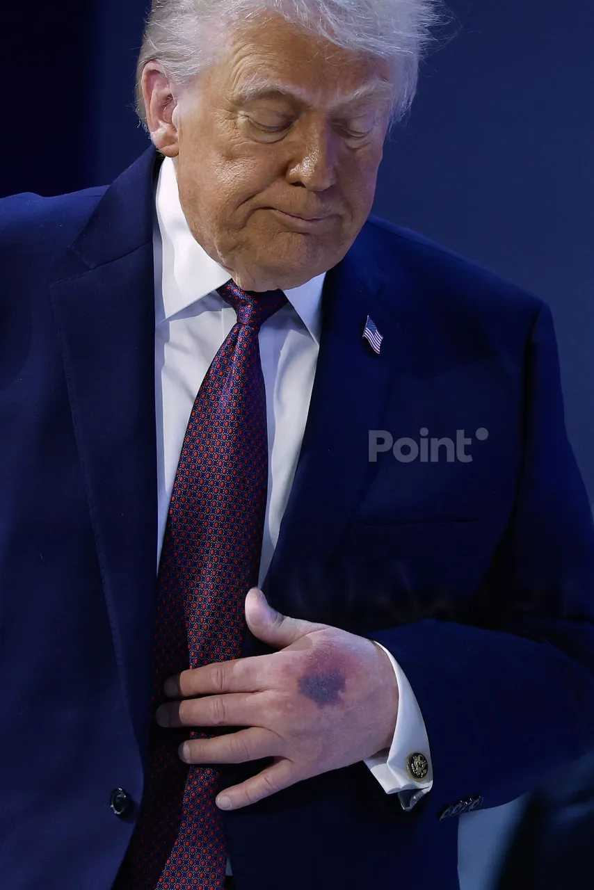 На руке Трампа увидели новый огромный синяк