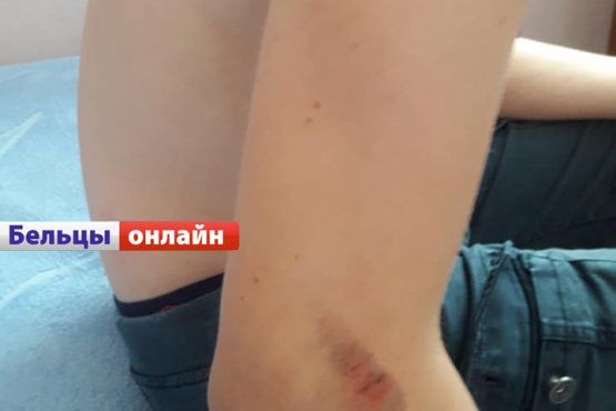 В Бельцах свора собак напала на 12-летнего мальчика