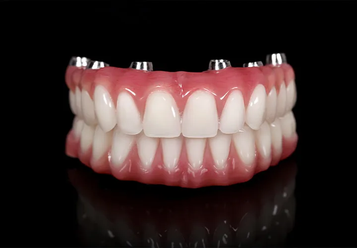 DentPark Moldova: Фиксированные зубы на имплантах  - функциональная и эстетичная улыбка