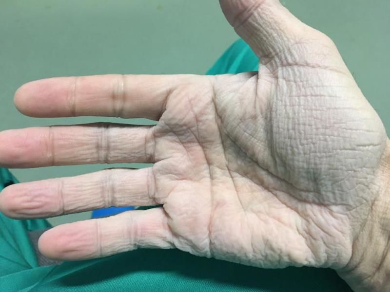 Cum arată mâna unui chirurg după 12 ore de operație