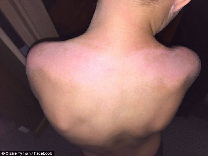Şocul unei mame, după ce şi-a dat copiii cu loţiune de plajă cu SPF 50: "Arată ca şunca prăjită"