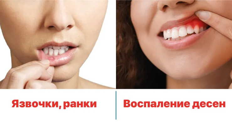 Революция в области гигиены полости рта: гель для десен Oramet с метронидазолом и хлоргексидином