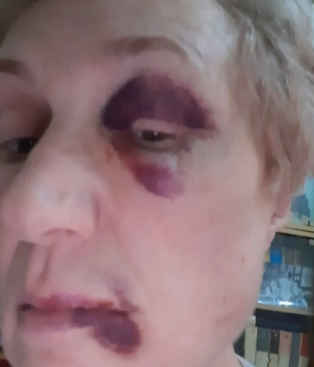 В Кишиневе избили женщину: Она била меня металлической тростью