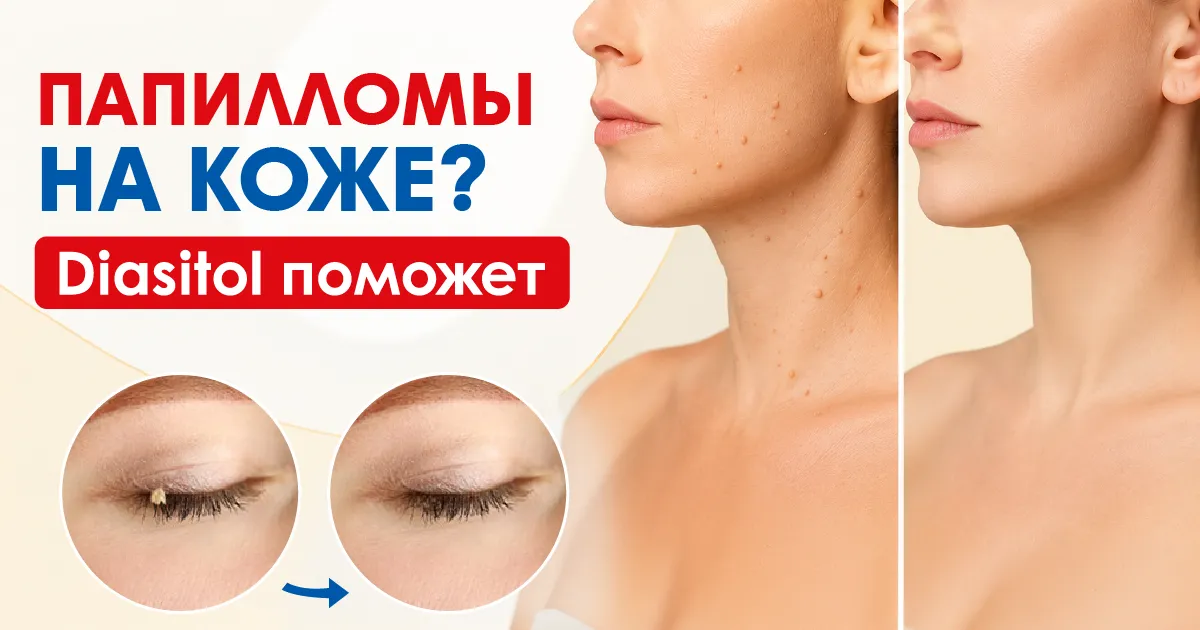 Diasitol поможет от папилломы на коже