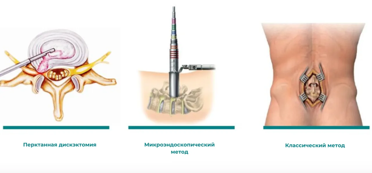 Medpark: Межпозвоночная грыжа. Какой метод выбрать: минимально инвазивный или классический