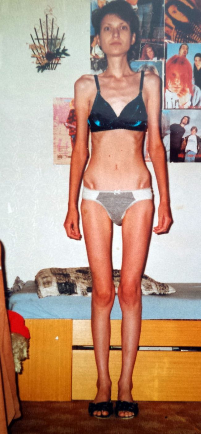 anorexie, femeie